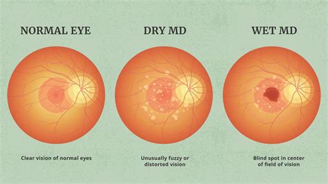amd eye disease